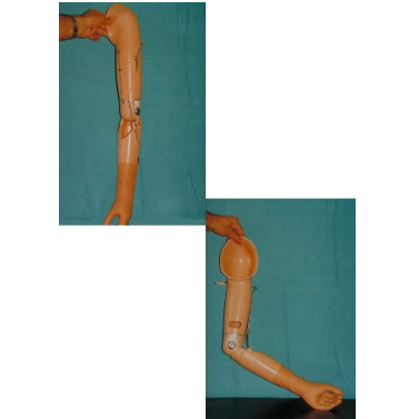 Transhumeral mechanical prosthesis