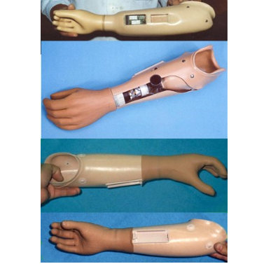 Transradial myoelectric prosthesis